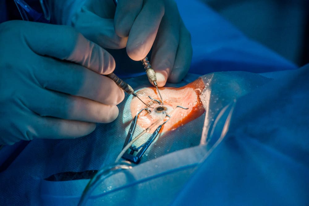 Cirugía de catarata