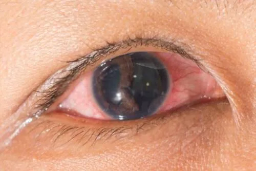 Especialista en Desprendimiento de Retina en Monterrey