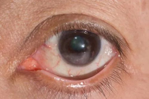 ¿Qué especialista trata el desprendimiento de retina?