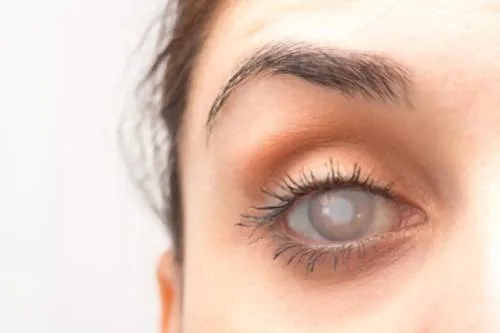 ¿Qué especialista trata el glaucoma?