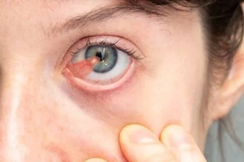 ¿Qué especialista trata la hemorragia ocular?