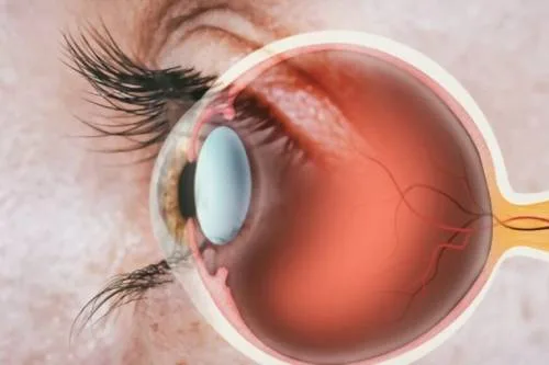 ¿Qué especialista trata la retinopatía diabética en Monterrey?
